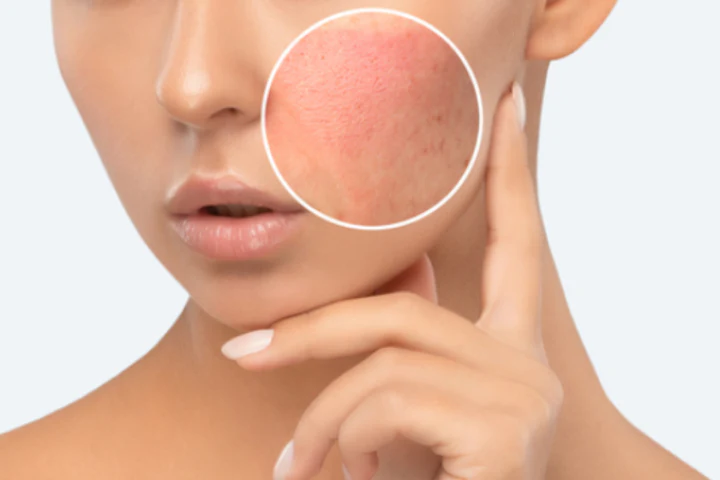 Contact Dermatitis