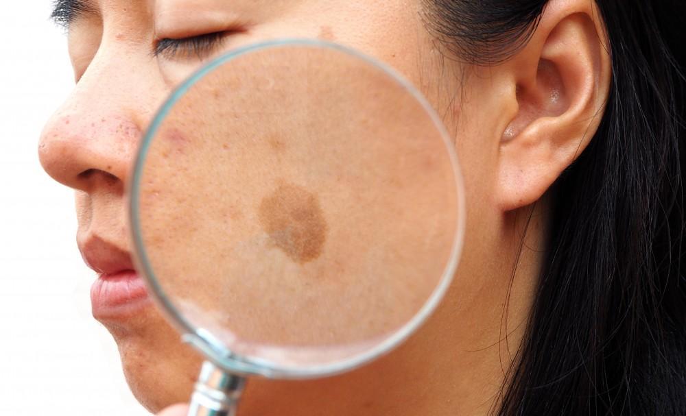 Actinic Keratosis