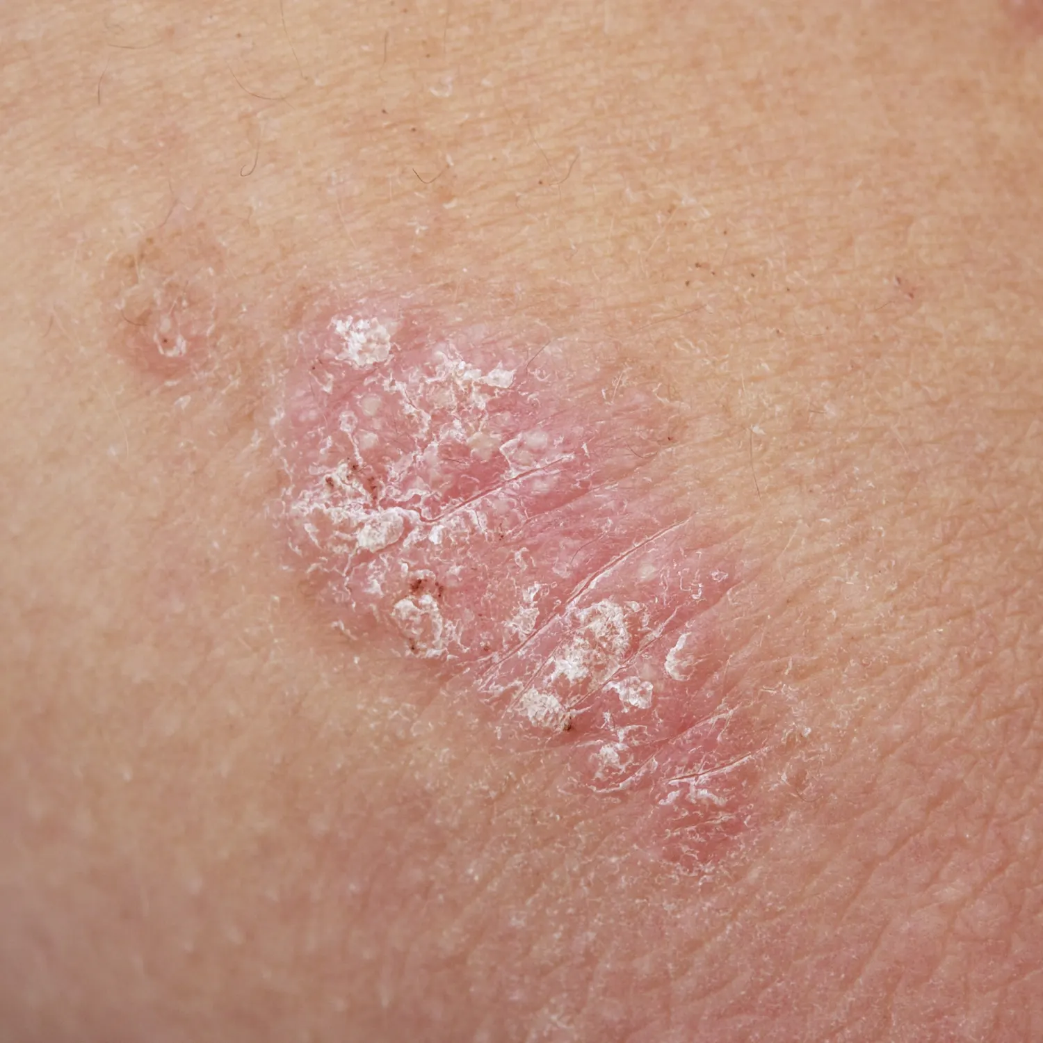Psoriasis